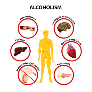 Alcoholism infographic with various diseases